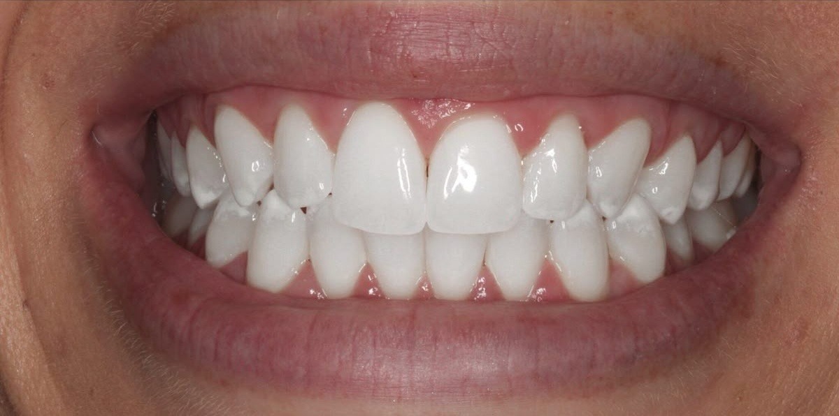 Smile Before Treatment