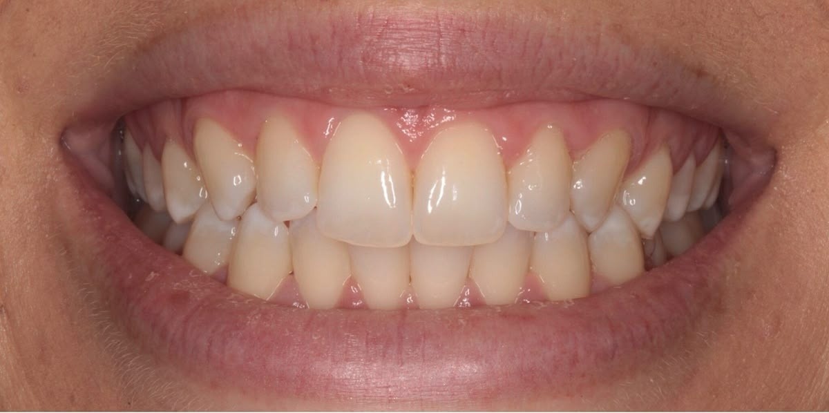 Smile After Treatment
